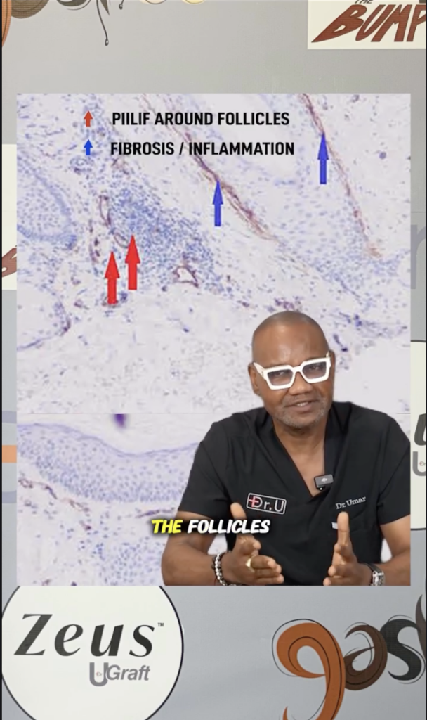 Dr. Sanusi Umar in front of a microscopic research image with red and blue arrows labeled PIILIF around follicles and fibrosis or inflammation.