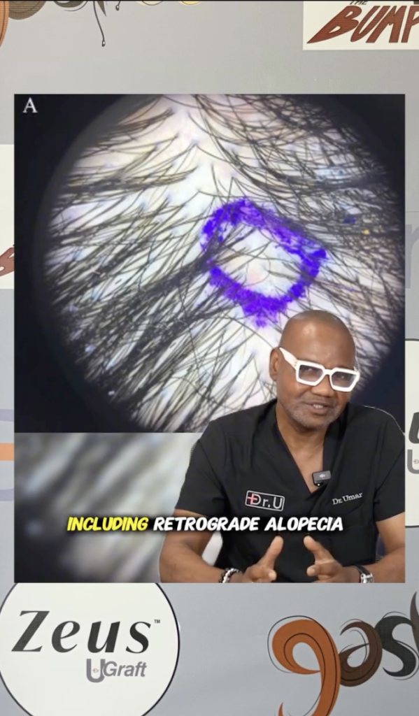 Close-up view of hair and scalp with a purple marked area, with Dr. Sanusi Umar speaking in the foreground and the words including retrograde alopecia on screen.