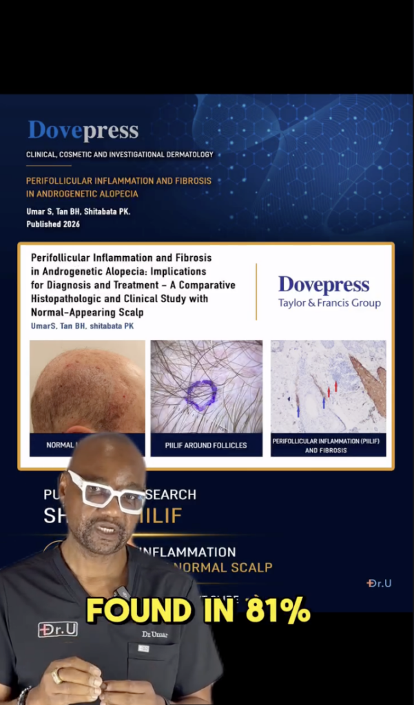 Dr. Sanusi Umar in front of a DovePress research graphic about perifollicular inflammation and fibrosis, with the words found in 81 percent.