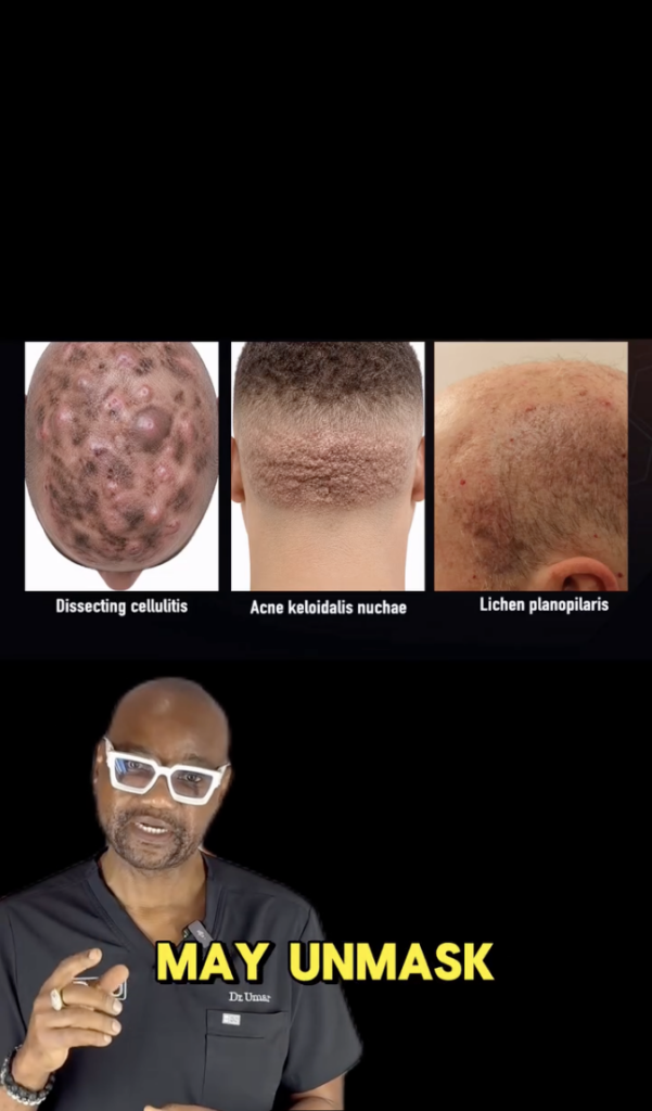 Three scalp photographs labeled Dissecting cellulitis, Acne keloidalis nuchae, and Lichen planopilaris, with Dr. Sanusi Umar speaking below.