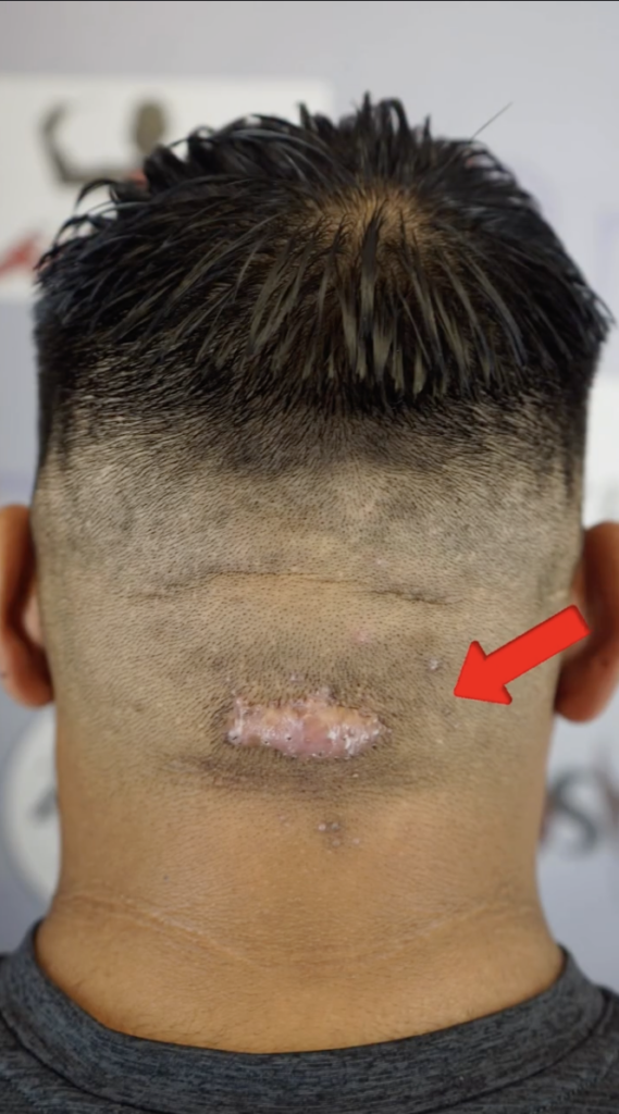 Back of Raul Ramirez’s head with a visible lower-scalp scar and a red arrow pointing toward the area.