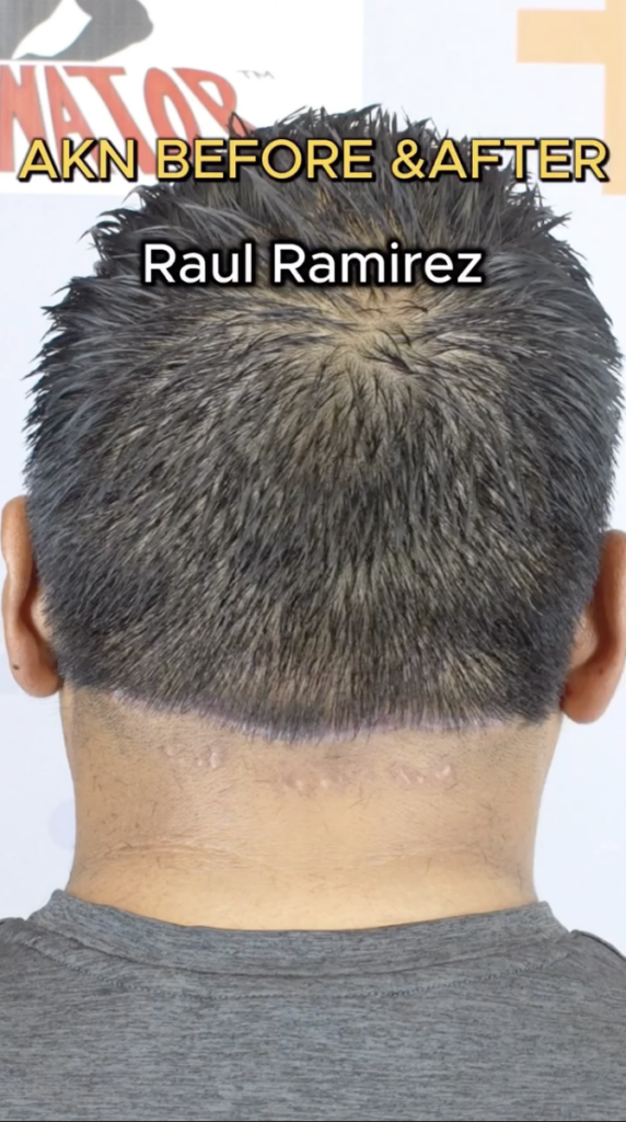 Back of Raul Ramirez’s head with short dark hair and on-screen text reading “AKN BEFORE & AFTER” and “Raul Ramirez.”