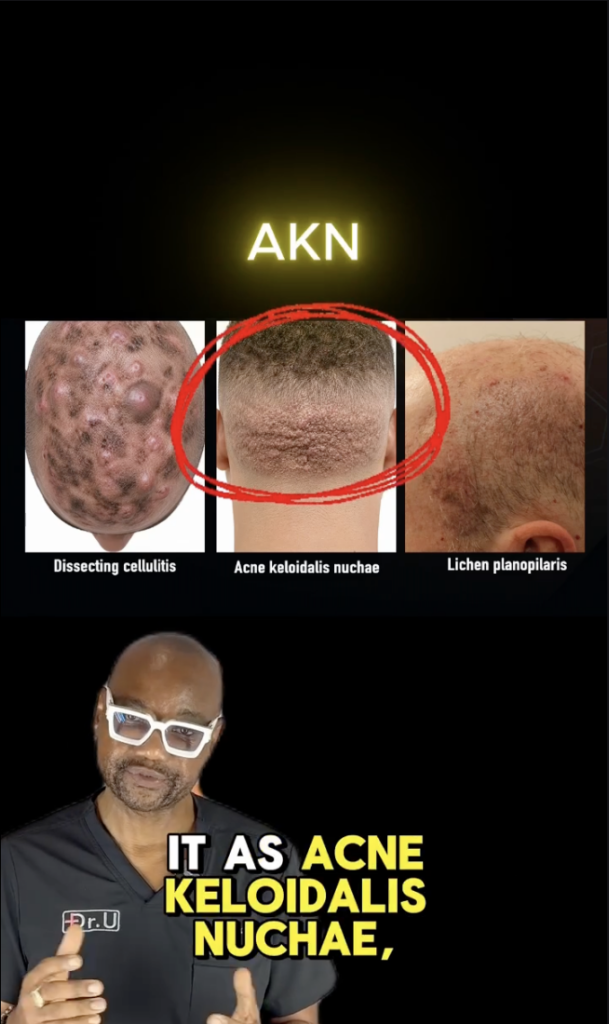 Dr. Sanusi Umar below three labeled scalp images, with acne keloidalis nuchae circled in red.