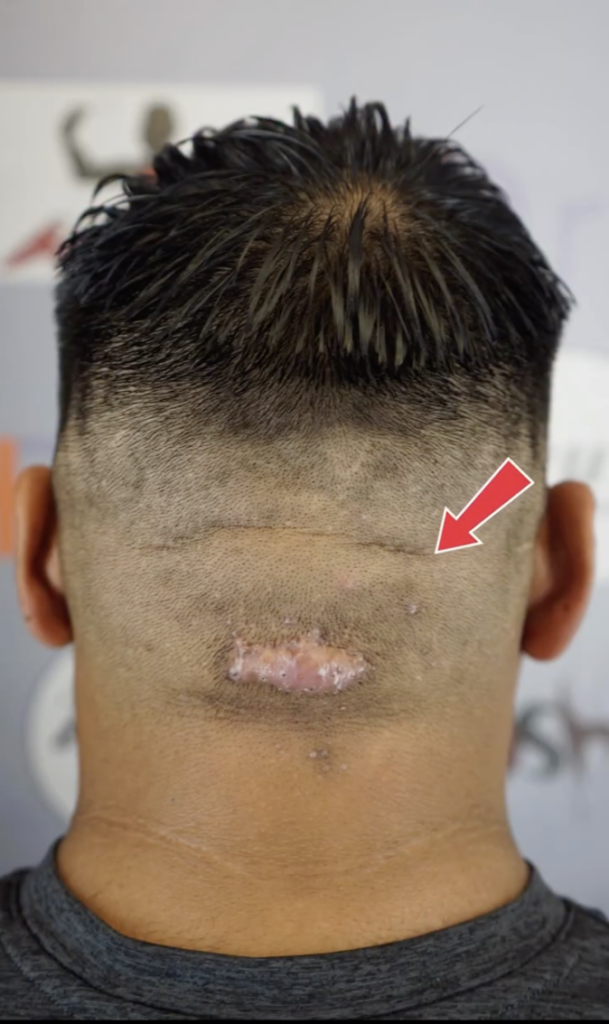 Back of a man’s closely cut head with a visible scar near the lower hairline and a red arrow pointing toward the area.
