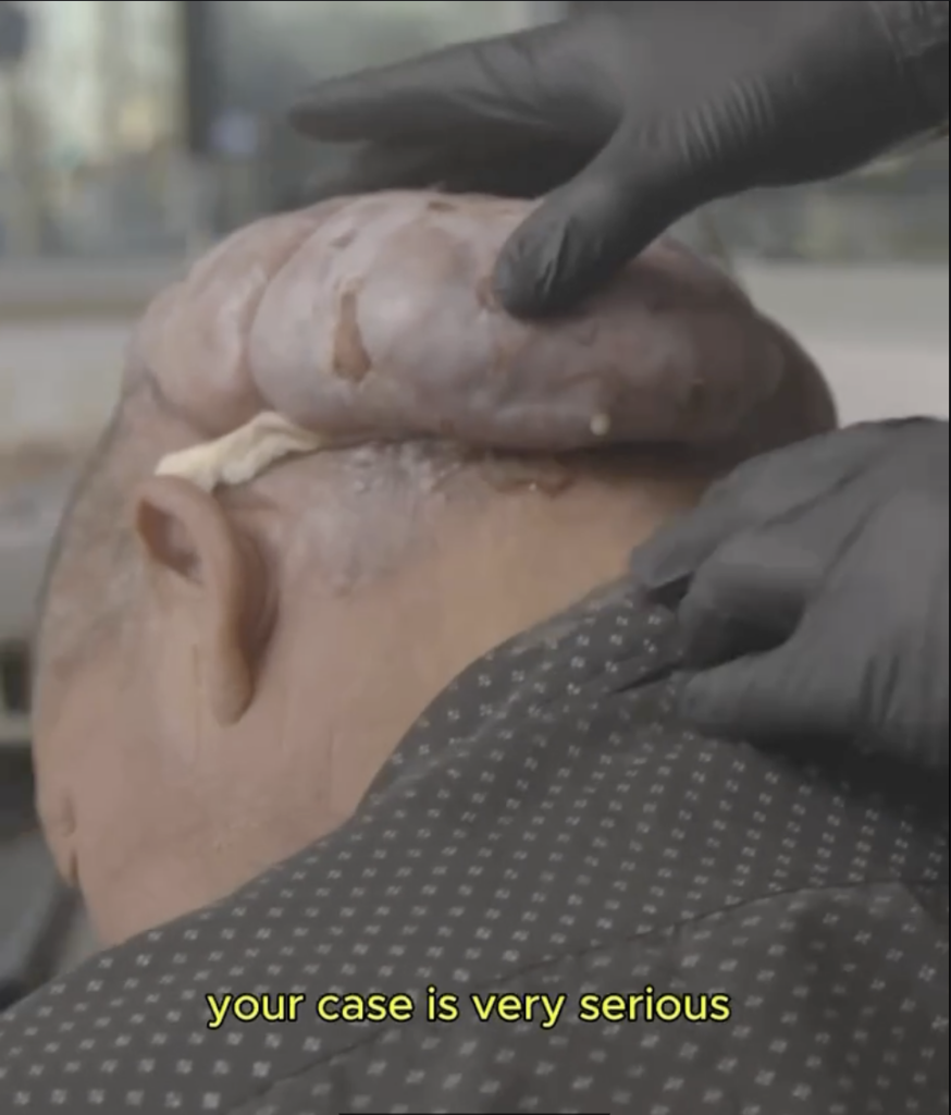 Close-up side view of a patient’s scalp with a large raised area while gloved hands examine the scalp.