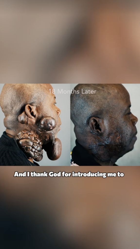Side-by-side profile images of Festus with large facial and neck growths on the left and a later profile image on the right, with text reading “18 Months Later.”