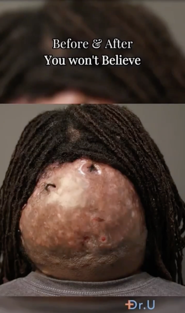 Back of a patient’s head with a large area of raised scalp tissue beneath locs.
