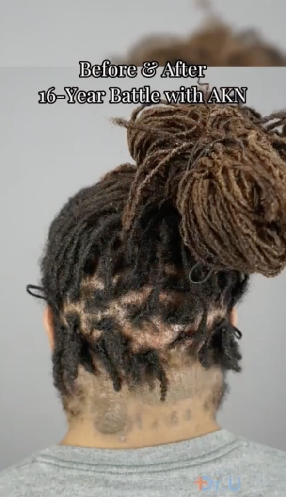 Back of a patient’s head with locs lifted to reveal the scalp and nape area.