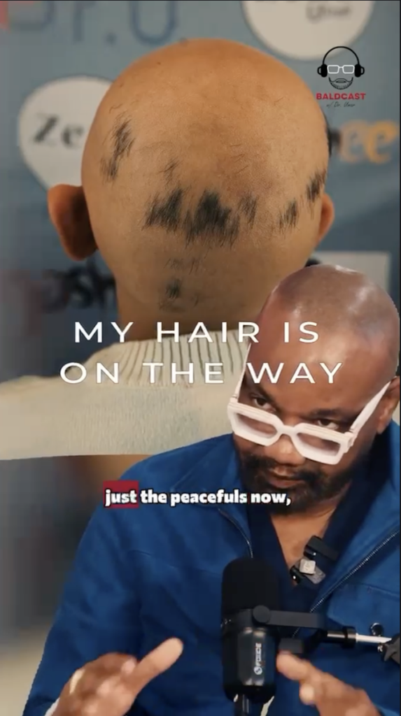Rear view of a shaved scalp with several patches of short dark hair above Dr. Sanusi Umar speaking into a microphone, with text reading My Hair Is On The Way.