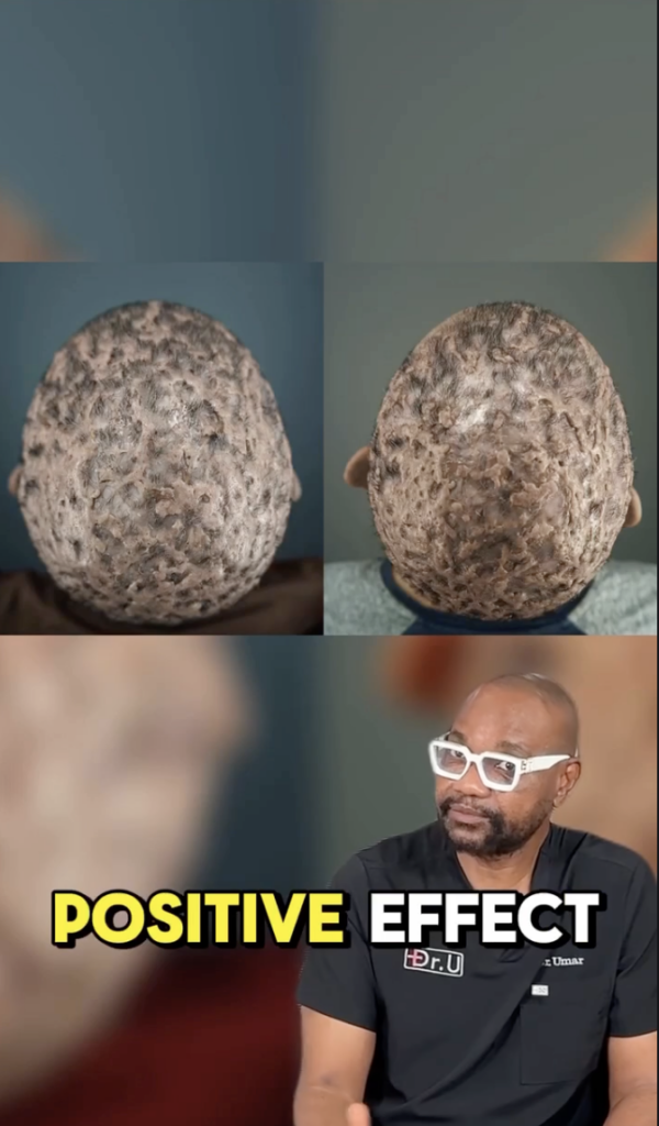Two overhead scalp images appear above Dr. Sanusi Umar in black scrubs and white glasses, with the words “POSITIVE EFFECT.”