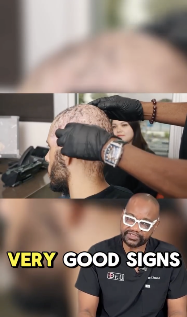 Black-gloved hands examine the side and back of a patient’s scalp above Dr. Sanusi Umar, with the words “VERY GOOD SIGNS.”