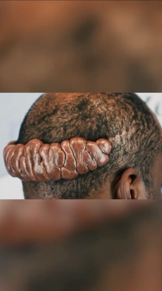 Raised segmented growth extending across the back of a man’s scalp.