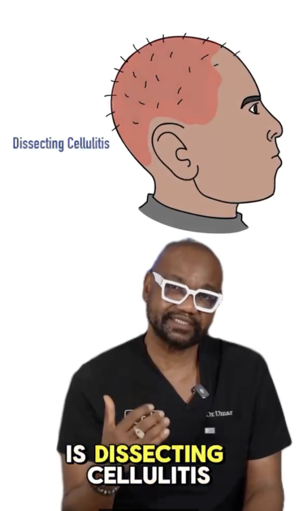 Side-profile scalp illustration labeled Dissecting Cellulitis above Dr. U speaking.
