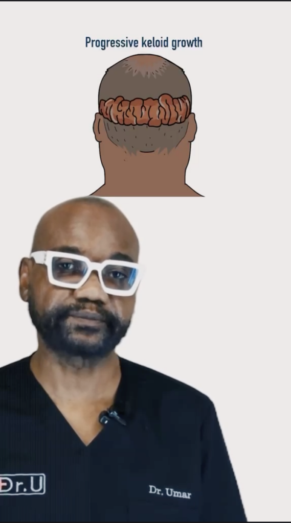 Dr. Umar in black scrubs below an illustration labeled “Progressive keloid growth.”