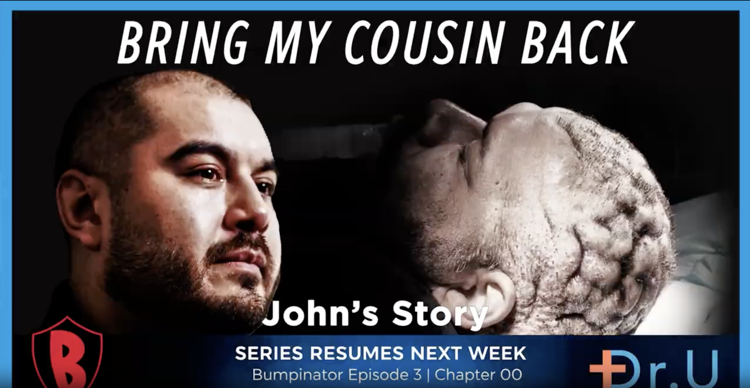 Scalp bump on Back of Head and AKN: John – Dr U Trailer | Bumpinator Ep 4