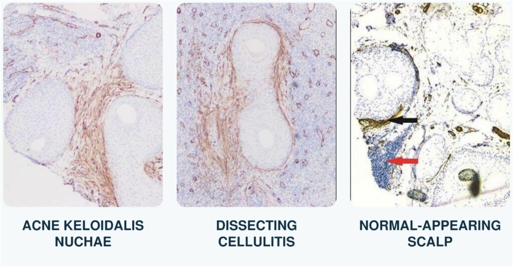 Three microscopic tissue images labeled acne keloidalis nuchae, dissecting cellulitis, and normal-appearing scalp, showing perifollicular staining, inflammation, and fibrosis.