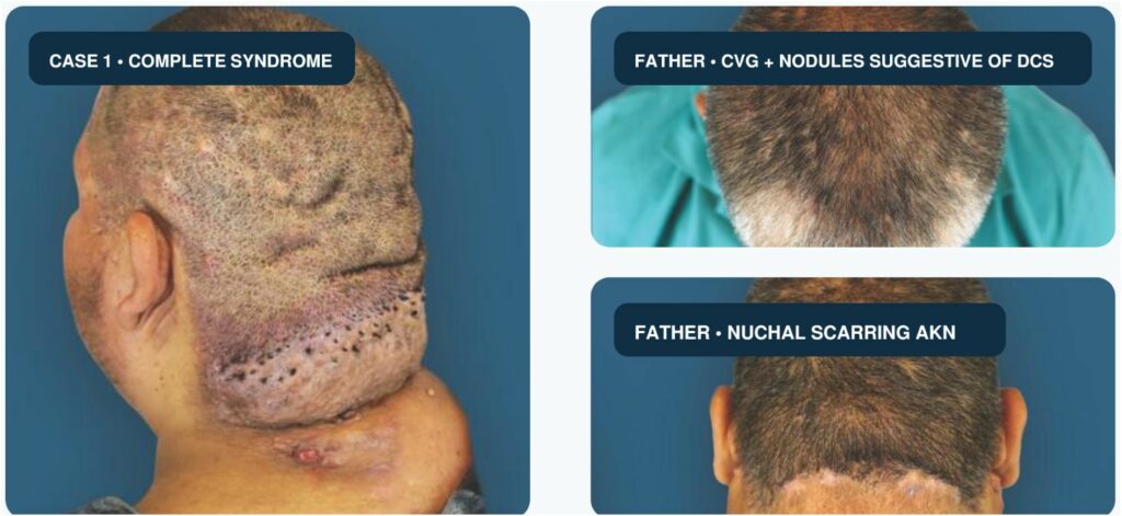 Composite clinical photographs of an anonymized patient with extensive scalp disease and his father, whose scalp shows diffuse folds, boggy-appearing nodules, and a posterior hairline plaque.