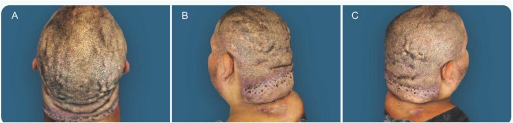 Posterior and bilateral posterior oblique photographs of an anonymized man showing a nuchal AKN mass, scalp nodules, scarring alopecia, and deep scalp furrows.