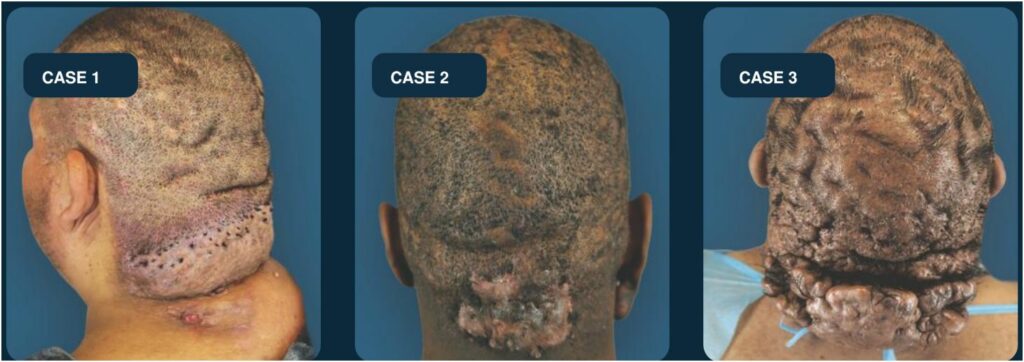 Three side-by-side posterior and oblique scalp photographs of anonymized men showing nuchal masses, inflammatory scalp nodules, scarring alopecia, and extensive scalp folds.