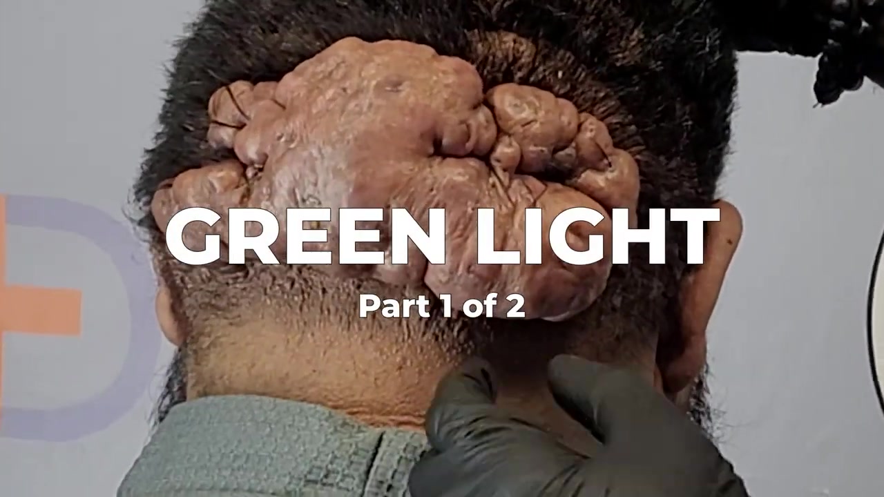 New Hats New Hope Part 1 John’s Surgery for Chronic Folliculitis of the Nape