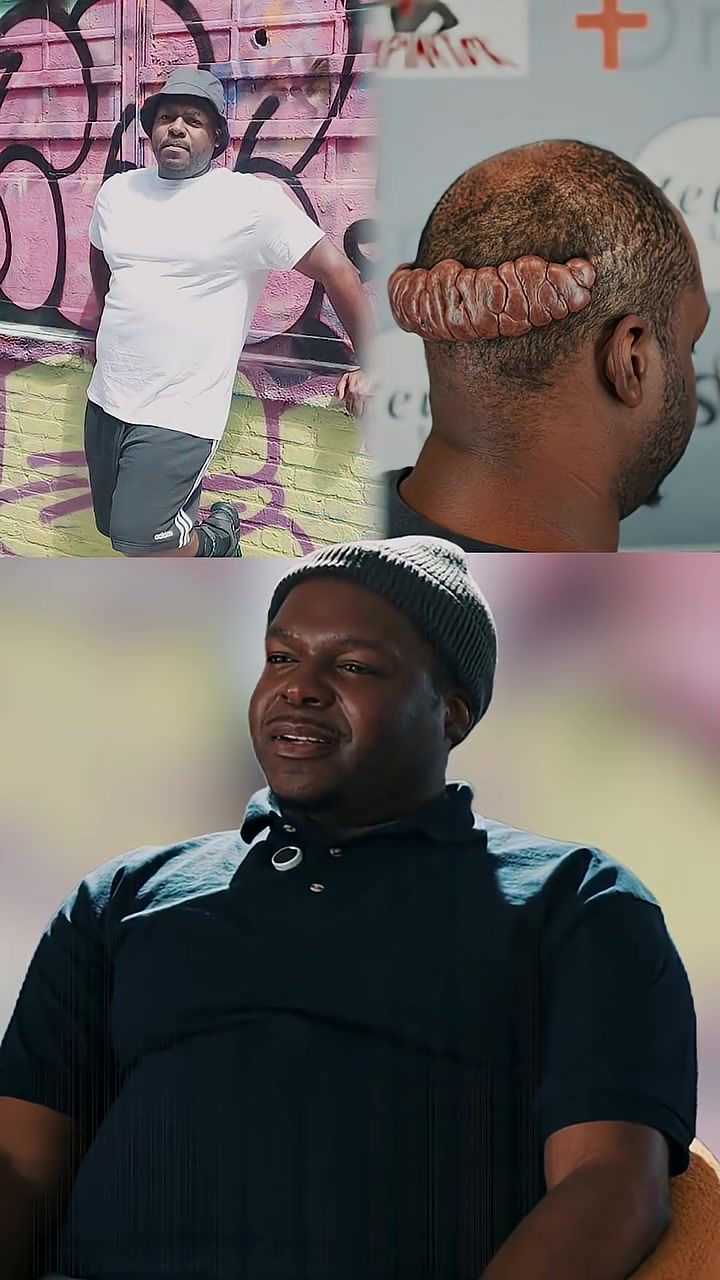 Marcus’ Keloid Kept Growing After His Hair Transplant