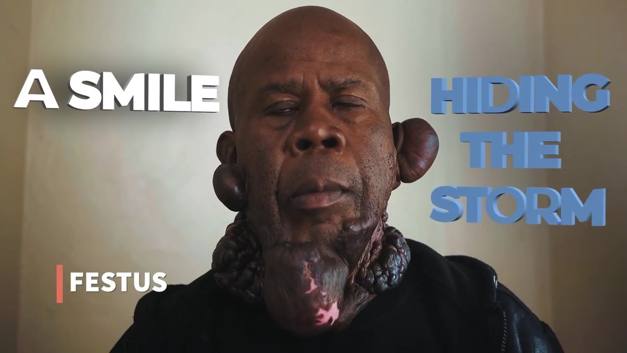 Severe Keloids and Overgrown Scar Tissue: Festus Trailer (Bumpinator Episode 3)