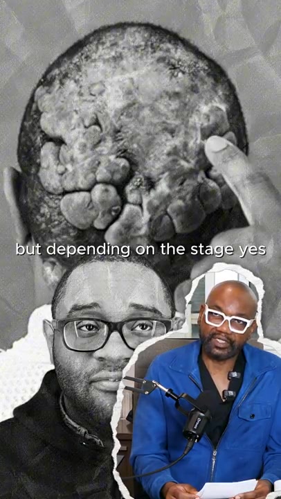 Is Acne Keloidalis Nuchae or Scalp Keloids painful for most people or does it depend on the stage?