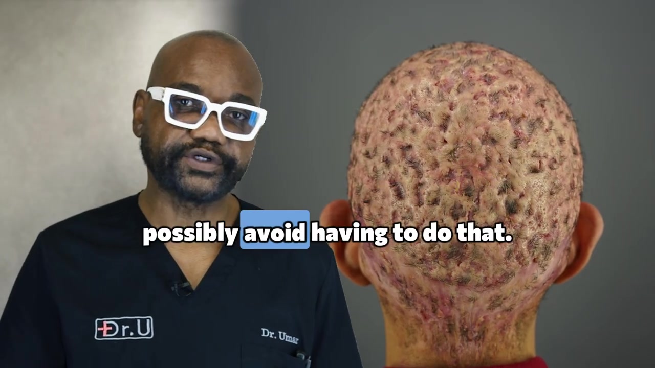 Ep 4 Ch 9: Why Dr. U Limits Heavy Steroids in Scarring Alopecia