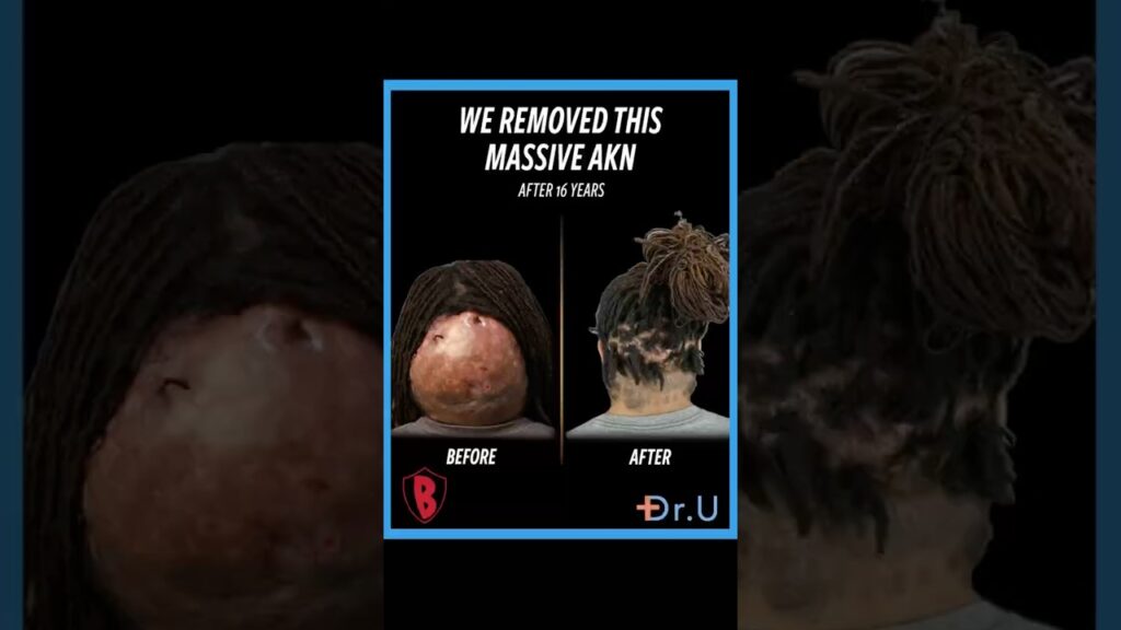 Video: After 16 Years With Acne Keloidalis Nuchae, One Surgery Marked a Turning Point