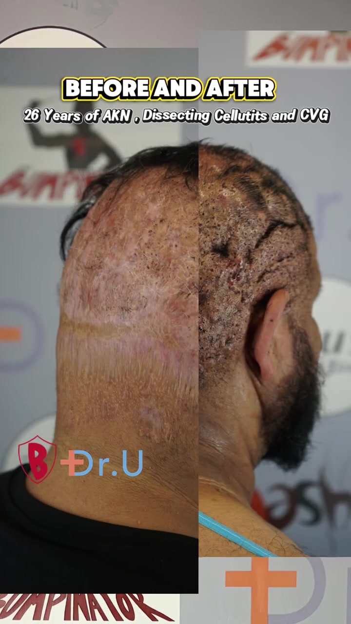 John's  AKN,  Dissecting Cellulitis, and CVG removed. Full Epsiode now on Youtube #akn #cvg #fyp #fy