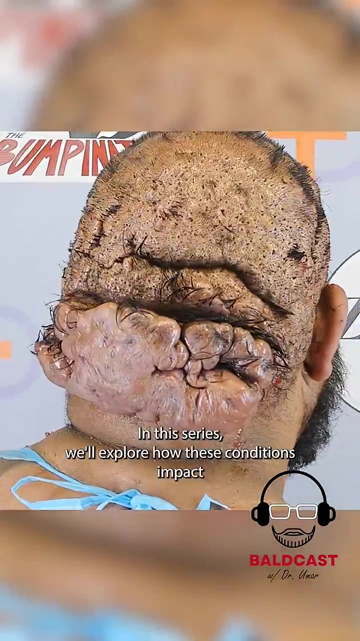 The Baldcast doesn’t just cover the surgery, it goes beyond #reels #shorts #podcast #explore #fy