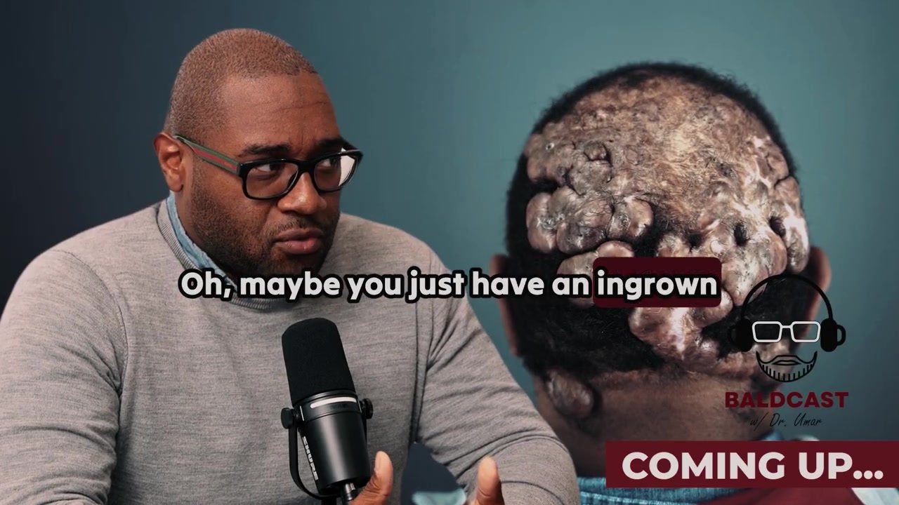 Misdiagnosed Scalp Condition: Anwar’s Story | Baldcast Trailer (AKN + Folliculitis Decalvans)