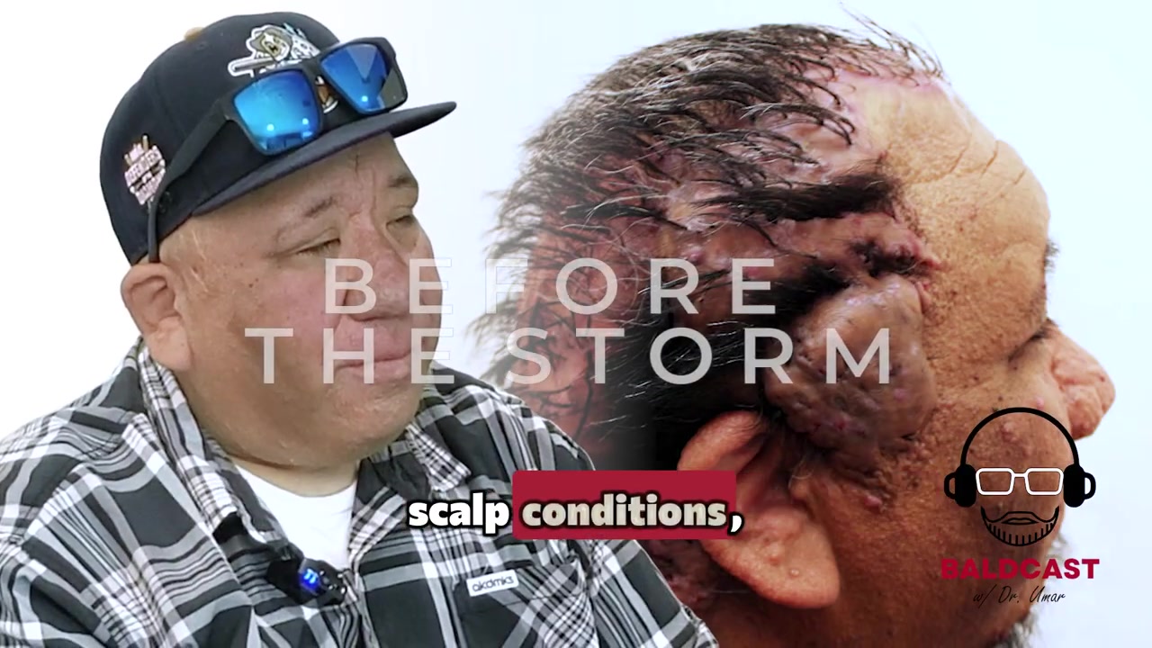 Robert’s Emotional Battle Living With Scalp Keloids | Before the Storm Part 2