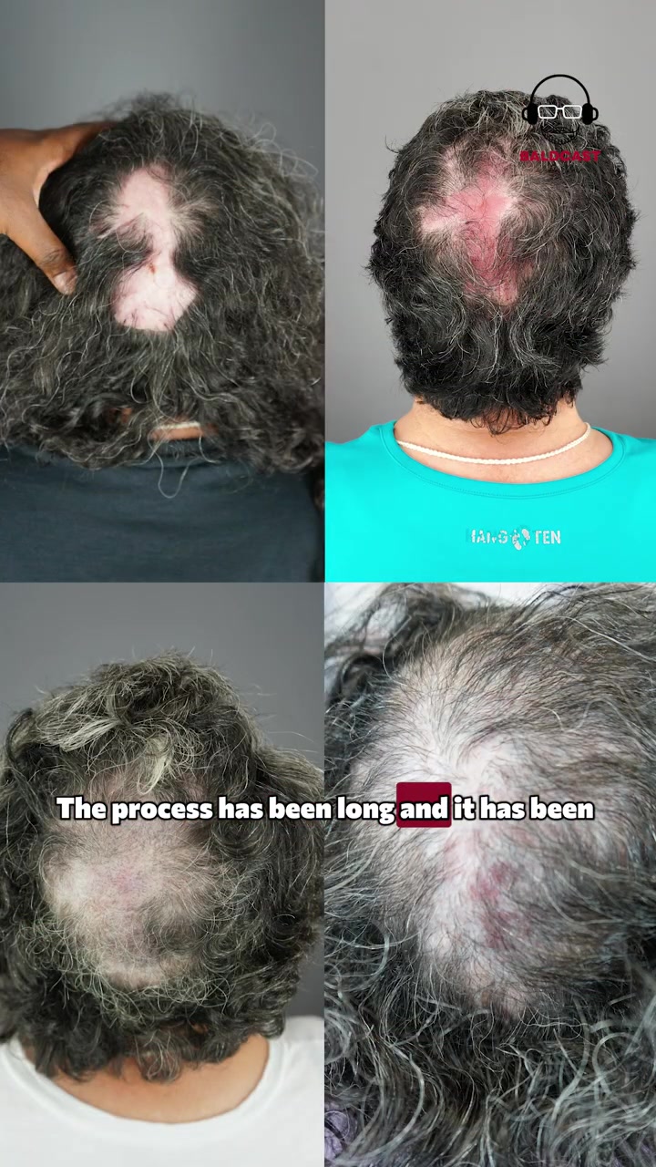 Seeking Help for Scalp Pustules: After 17 Years, Pain-Free in Days | Maria Landeros