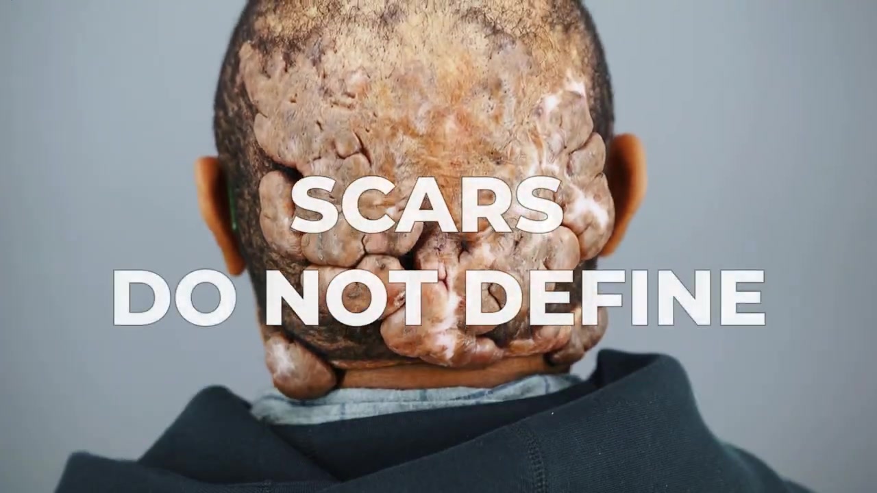 The Courage to Be Seen After Removal of Acne Keloidalis Nuchae and Folliculitis Decalvans