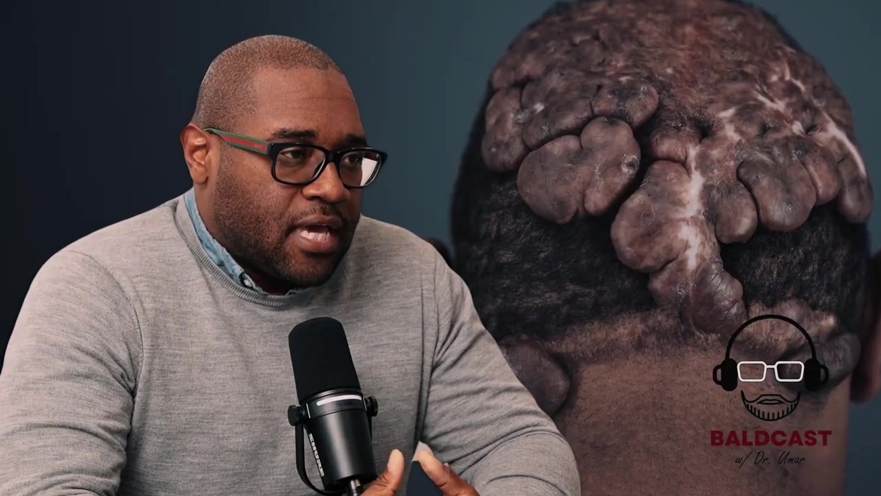 Anwar’s Severe AKN & Folliculitis Decalvans Journey | Full Baldcast Episode