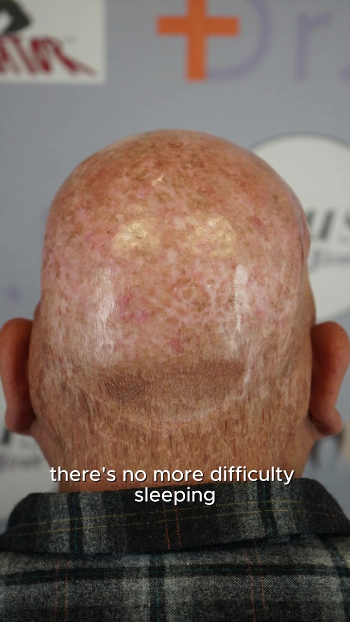 Life After Acne Keloidalis Nuchae (AKN) Removal | Robert’s Story