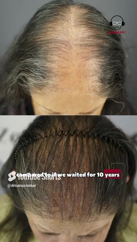Dancing the Game of Life With Scalp Scarring and Hair Loss | Maria Chica’s Story