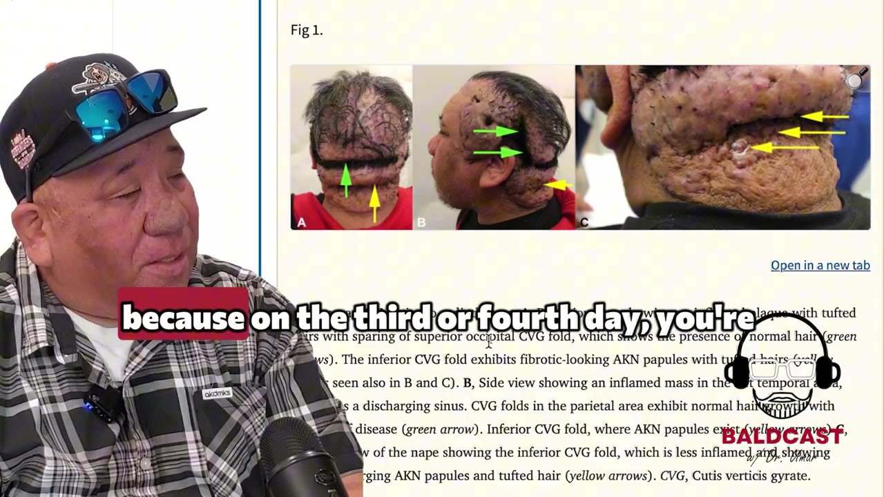 Beyond What Is Called Cosmetic Cicatricial Folliculitis and Folliculitis Decalvans | Robert's Story