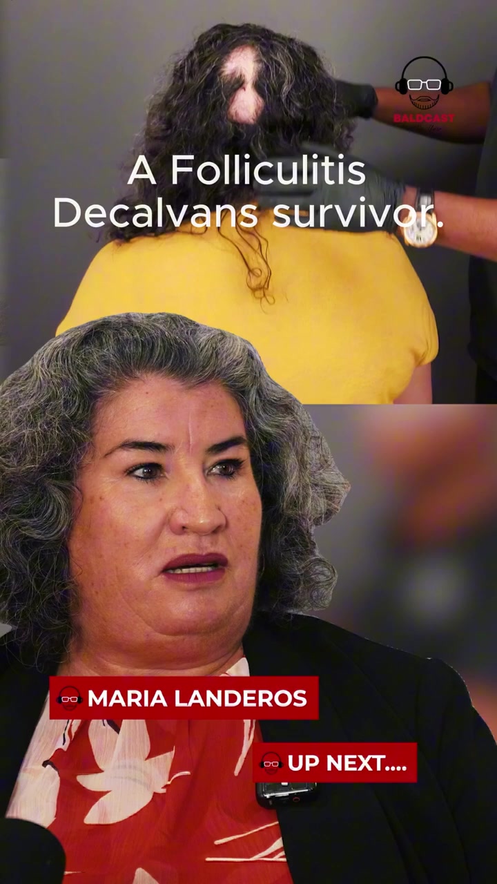 Is Scarring Alopecia Permanent? One Question. Two Lives