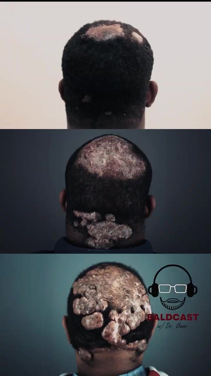 Painful scalp bumps with hair loss are not always simple folliculitis #scalphealth